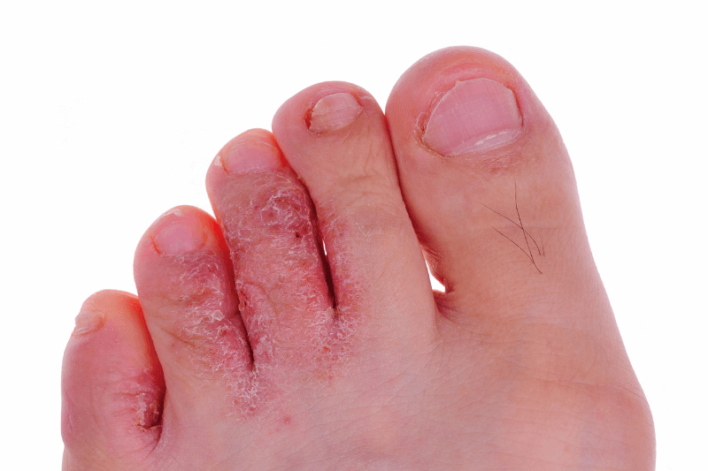 Mediciner.in - Home remedy for skin fungal infection | 2025 Athletes foot 2025