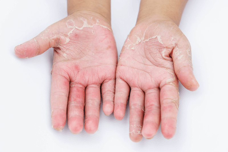 Mediciner.in - Home remedy for skin fungal infection | 2025 Skin Infection 2025