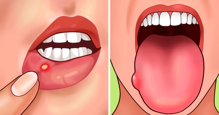 Mediciner.in - Foods that are ulcer busters | 2025 Ulcer