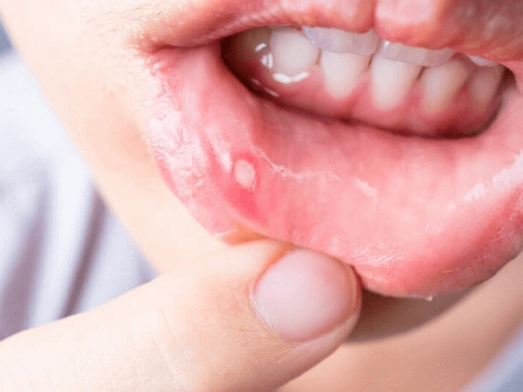 Mediciner.in - Eyewear | 2025 Foods that are ulcer busters
