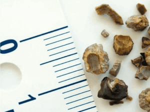 KIDNEY STONES: Know it all