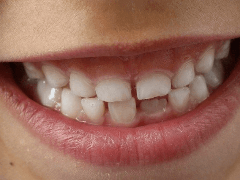 Mediciner.in - Eyewear | 2025 Missing Teeth: How to fix this dental issue?