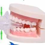 Mediciner.in - AlexVyan® - Advanced Tongue Anti Snoring Device - Snore Stopper Relief Guard - Allows a Restful Night's Sleep - Comfortably Prevents Snoring | 2025 AlexVyan Genuine Accessory Advanced Tongue Anti Snoring Device Medical Silicone Sleep Best Health Care Stop Snoring Device Sleep Now Snore Solutions Device Snore Stopper Relief Guard Sleep Aid reduces 0 2 2025